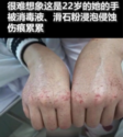 疫情期間，22歲醫護人員胡佩的手被消毒水和滑石粉浸泡侵蝕的傷痕累累